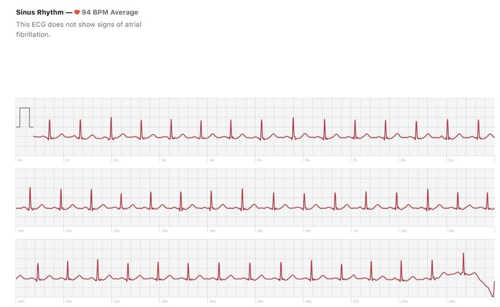 My Apple Watch Detected AFib - Dr. John Day, Cardiologist